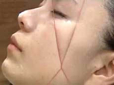 糸で脱毛してお肌ツルツル 美白効果